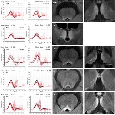 Altered Resting-State Functional Connectivity in Wernicke's Encephalopathy With Vestibular Impairment